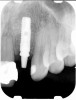 Figure 2 Identification of sufficient inter-radicular space: The radiographic representation of inter-radicular space (Fig 2) reveals abundant space for a single-tooth implant; at the alveolar crest, 
> 6 mm of interproximal space is available for placeme
