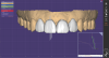 Fig 10. Front view of computer-aided design and manufacture of final porcelain veneers.