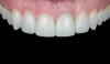 Fig 13. Retracted view of final lithium-disilicate veneer restorations.