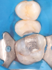 Fig 1 through Fig 5. Single-visit restoration of a maxillary second premolar following root canal treatment. Fig 1: Morphology-guided overlay preparation. Fig 2: IOS bite registration via imaging of buccal tooth surfaces. Fig 3: Preparation margin defined following IOS impression. Fig 4: Overlay design on the IOS platform, integrating adjacent tooth anatomy. Fig 5: Bonded overlay fabricated from CAD/CAM resin-based composite. Fig 6 through Fig 9. Digital workflow for guided endodontics using a digital twin, created by registering an IOI with CBCT data.