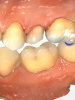 Fig 1 through Fig 5. Single-visit restoration of a maxillary second premolar following root canal treatment. Fig 1: Morphology-guided overlay preparation. Fig 2: IOS bite registration via imaging of buccal tooth surfaces. Fig 3: Preparation margin defined following IOS impression. Fig 4: Overlay design on the IOS platform, integrating adjacent tooth anatomy. Fig 5: Bonded overlay fabricated from CAD/CAM resin-based composite. Fig 6 through Fig 9. Digital workflow for guided endodontics using a digital twin, created by registering an IOI with CBCT data.