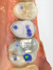 Fig 1 through Fig 5. Single-visit restoration of a maxillary second premolar following root canal treatment. Fig 1: Morphology-guided overlay preparation. Fig 2: IOS bite registration via imaging of buccal tooth surfaces. Fig 3: Preparation margin defined following IOS impression. Fig 4: Overlay design on the IOS platform, integrating adjacent tooth anatomy. Fig 5: Bonded overlay fabricated from CAD/CAM resin-based composite. Fig 6 through Fig 9. Digital workflow for guided endodontics using a digital twin, created by registering an IOI with CBCT data.