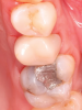 Fig 1 through Fig 5. Single-visit restoration of a maxillary second premolar following root canal treatment. Fig 1: Morphology-guided overlay preparation. Fig 2: IOS bite registration via imaging of buccal tooth surfaces. Fig 3: Preparation margin defined following IOS impression. Fig 4: Overlay design on the IOS platform, integrating adjacent tooth anatomy. Fig 5: Bonded overlay fabricated from CAD/CAM resin-based composite. Fig 6 through Fig 9. Digital workflow for guided endodontics using a digital twin, created by registering an IOI with CBCT data.