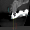 Fig 8: Virtual planning of the endodontic access cavity for this complex case, involving a calcified root canal in a lateral incisor that also serves as an abutment tooth for a fixed dental prosthesis.