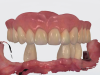 Fig 10 and Fig 11. Application of an IOS in the prosthodontic rehabilitation of a patient with a fully edentulous upper arch and a partially edentulous lower arch. Fig 10: IOS imaging of the maxillary full denture, both independently and in situ, supports occlusal registration, preliminary vertical dimension assessment, and, if needed, fabrication of individual impression trays or a surgical stent for implant placement. Fig 11: Merged IOIs, combining scans captured with and without the removable prostheses in situ, establish a precise digital foundation for treatment planning and final prosthesis fabrication.