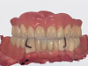 Fig 10 and Fig 11. Application of an IOS in the prosthodontic rehabilitation of a patient with a fully edentulous upper arch and a partially edentulous lower arch. Fig 10: IOS imaging of the maxillary full denture, both independently and in situ, supports occlusal registration, preliminary vertical dimension assessment, and, if needed, fabrication of individual impression trays or a surgical stent for implant placement. Fig 11: Merged IOIs, combining scans captured with and without the removable prostheses in situ, establish a precise digital foundation for treatment planning and final prosthesis fabrication.