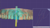 (4.) Design software view of a cement-retained implant crown that was later converted to screw-retained.