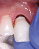 (6.) Delivery of the final screw-retained implant crown.