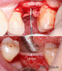 Fig 4. Vertical soft-tissue thickness plays an important role in the etiology of crestal bone loss.