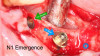 Fig 8. N1 implants with N1 Base (blue arrow) and without N1 Base (green arrow).