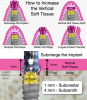 Fig 9. Various approaches to increase vertical soft tissue.