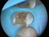(2.) Close-up occlusal view of a maxillary first premolar during restorative treatment revealing a mesial structural crack.
