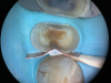 (5.) Close-up occlusal view of the modified copper band placed to isolate the margin during deep margin elevation and stabilized with a wedge and a piece of polytetrafluoroethylene tape.