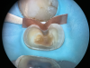 (6.) Absolute adaptation and isolation was achieved with the copper band, conforming to the unique anatomy of the upper premolar.