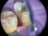 (10.) A close-up distolingual view of a mandibular molar after the removal of caries that extended to the bone level.