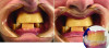 Figure 4: VDO registration and bite taking. Photograph by Andrew Goss, DDS.