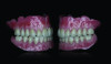 Figure 10: Finished analog denture with staining and glazing. Photo by Miles R. Cone, DMD.