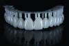Figure 14: Printed teeth with high-impact resin.