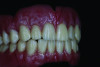 Figure 15: Finished milled denture with staining and glazing.