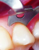 Fig 3. This photograph shows the microscopic detection of a clamp tip improperly resting on the marginal gingival tissue, a problem that can potentially leave the tissue exposed.