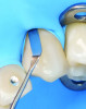 Fig 9. After microscopically identifying an uncovered occlusal surface next to the anchor tooth, fast, effective rubber dam inversion can be completed under the DOM.