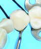 Fig 11. A flat gingival retraction cord plugger is used to ensure the floss tie is secured palatally beyond the tooth’s bulbosity cervically under the DOM.