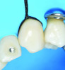 Fig 12. The knot is tightened around the tooth’s neck by pulling the free ends apart to ensure secure stabilization around the target tooth. (This photograph does not show the final position of the floss within the sulcus, but rather illustrates the technique in progress.)