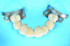 Fig 13. Occlusal view of rubber dam placement under the DOM, demonstrating full coverage of the treatment area.