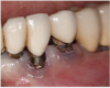 Fig 3 and Fig 4. Pre- (Fig 3) and post-treatment (Fig 4) photographs of a patient who received free gingival grafting at implant sites Nos. 21 and 22. Note the increased amount of keratinized tissue at the areas postoperatively (Fig 4). The patient was placed on 3-month supportive peri-implant care post-surgery and reported increased comfort during her home care regimen.