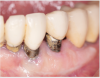 Fig 3 and Fig 4. Pre- (Fig 3) and post-treatment (Fig 4) photographs of a patient who received free gingival grafting at implant sites Nos. 21 and 22. Note the increased amount of keratinized tissue at the areas postoperatively (Fig 4). The patient was placed on 3-month supportive peri-implant care post-surgery and reported increased comfort during her home care regimen.