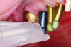 (1.) Intraoral view of a QPD device being used on a dental implant to assess its osseointegration and detect any potential instability.