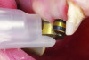 (4.) Intraoral view of a QPD device being used on a healing abutment to evaluate structural stability during the postsurgical healing phase.