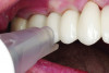 (5.) Intraoral view of a QPD device being applied to a crown on a natural tooth to identify signs of structural instability or compromised integrity.