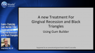 Game-Changing Gum Builder Filler Treatment for Gingival Recession and Black Triangles Webinar Thumbnail