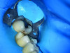(4.) Intraoral images of a lower first molar before and after air abrasion to create a biobase. The accumulated aluminum oxide particles highlights the amount of abrasive used and the necessity of a rubber dam to prevent them from being inhaled or spread in the mouth.