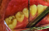Fig 1 through Fig 3. Measurements of lingual attached gingiva: Fig 1 = identifying the MGJ.