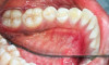 Fig 7. Lingual attached gingiva in a female subject: Fig 7 = left side, Fig 8 = middle, Fig 9 = right side.