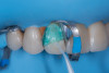 (9.) Protection of adjacent teeth and the dentin tissue during surface treatment of the fractured ceramic margin.