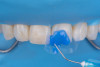 (22.) Intraoral view after rubber dam isolation, showing prepared surfaces: both sandblasted and etched, with silanization applied only to the composite surface, ready for reattachment.