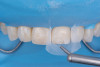(23.) Intraoral view after rubber dam isolation, showing prepared surfaces: both sandblasted and etched, with silanization applied only to the composite surface, ready for reattachment.