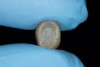 (28.) Intaglio surface of a loosened crown, showing all residual cement firmly adhered to the internal surface.
