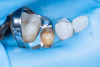 (30.) Intraoral view after absolute isolation with a rubber dam, showing the prepared tooth surface cleaned and roughened with sandblasting, ready for adhesive application and bonding to the crown.