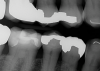 (40.) Fractured cusp after adhesive bonding and polishing of the finish line, resulting in a smooth and seamless transition and 25-month follow up radiograph where the adhesively bonded fracture line is visible.