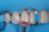 (12.) Final polishing of the reattached ceramic to create an invisible fracture line and restore seamless esthetics.