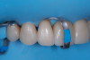 (13.) Final polishing of the reattached ceramic to create an invisible fracture line and restore seamless esthetics.