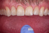 (16.) Intraoral view showing the fractured ceramic fragment positioned in place. The piece fits well, although minor gaps are present between the margins due to slight material loss, which can be restored using luting composite.