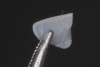 (17.) Mixed cohesive failure of the restoration, with a very small amount of adhesive remaining on the fragment, while the majority of the fractured surface shows fresh composite, indicating cohesive failure within the material.