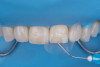 (24.) Intraoral view after rubber dam isolation, showing prepared surfaces: both sandblasted and etched, with silanization applied only to the composite surface, ready for reattachment.