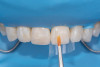 (25.) Correction and removal of composite excess, followed by light polymerization.