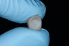 (29.) Intaglio surface of the crown after sandblasting and ultrasonic cleaning, followed by application of an MDP-containing adhesive to enhance bonding.